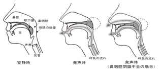 開鼻声