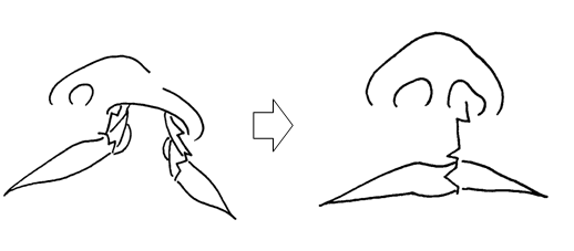 口唇裂の手術(口唇形成術)