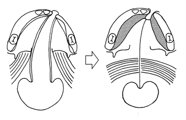 口蓋裂の手術(プッシュバック法)