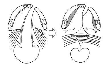 口蓋裂の手術（ファーロー法）