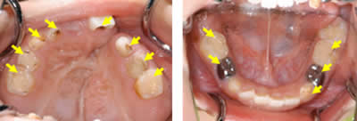 口の中に出来た多くの虫歯と虫歯を治療した跡