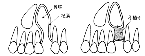 歯槽裂(顎裂)部への骨移植術