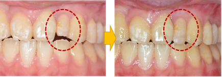 矯正治療後の修復治療（左；矯正治療終了時　右；修復処置後）