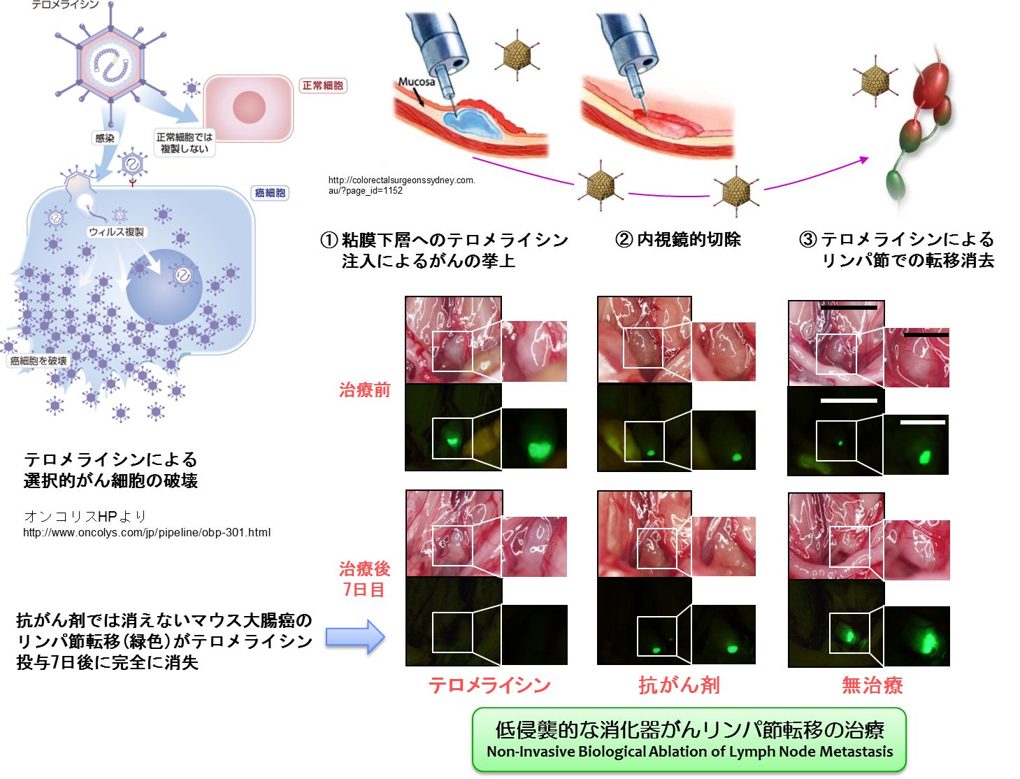 がん細胞のリンパ節転移を完全に消去する新たな遺伝子改変ウイルス製剤を用いた治療法の開発 国立大学法人 岡山大学