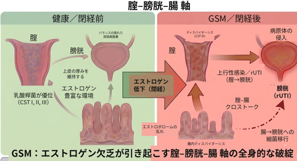 閉経後の頻尿や膣・外陰部症状，”膣・膀胱・腸の細菌の繋がり”が関与か～世界23研究・5,027人の解析から，GSM（閉経関連尿路性器症候群）に対する「膣-膀胱-腸 軸」という新たな考え方を提唱
