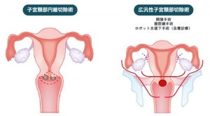 子宮を切除することなく子宮頸がんを治す取り組み～治療終了後の妊娠が可能に～