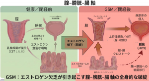 閉経後の頻尿や膣・外陰部症状，”膣・膀胱・腸の細菌の繋がり”が関与か～世界23研究・5,027人の解析から，GSM（閉経関連尿路性器症候群）に対する「膣-膀胱-腸 軸」という新たな考え方を提唱