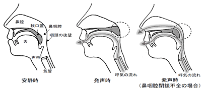 鼻咽腔閉鎖不全