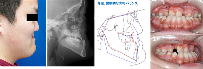 上あごの骨の後退感によって受け口の顔貌を呈している